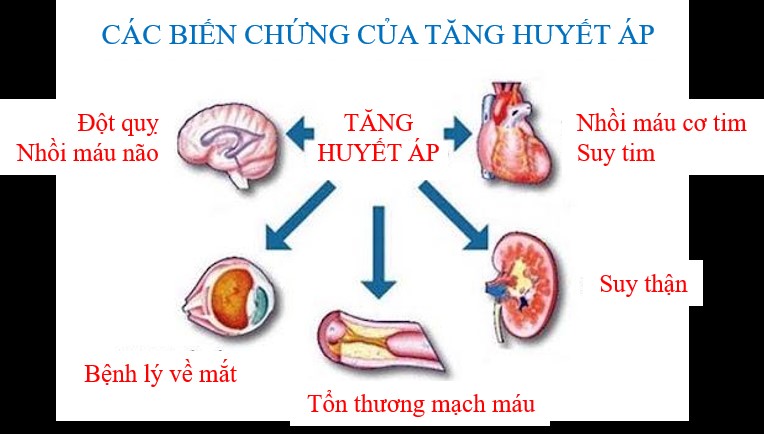 Tai biến mạch máu não do tăng huyết áp: Những dấu hiệu nhận biết để phòng tránh tốt nhất