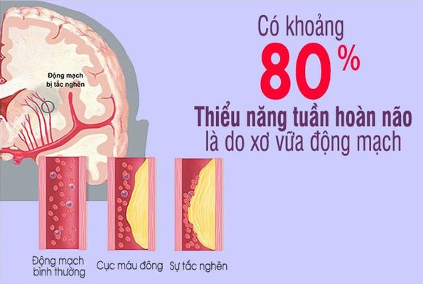 Biến chứng thiểu năng tuần hoàn não: Không điều trị sớm, đột quỵ cận kề