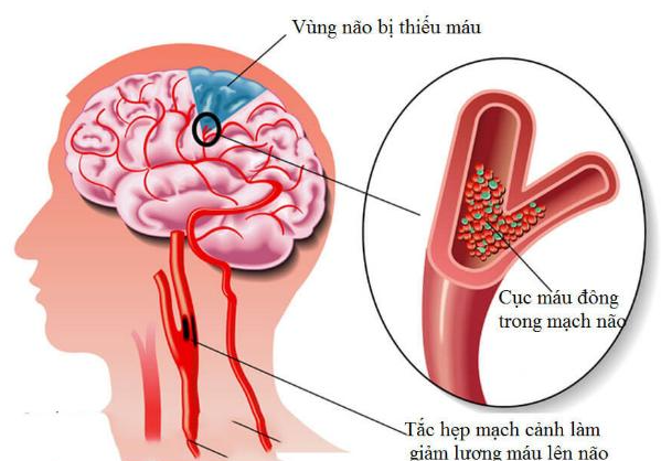 Chẩn đoán thiểu năng tuần hoàn não: Phát hiện sớm ngăn ngừa nguy hiểm