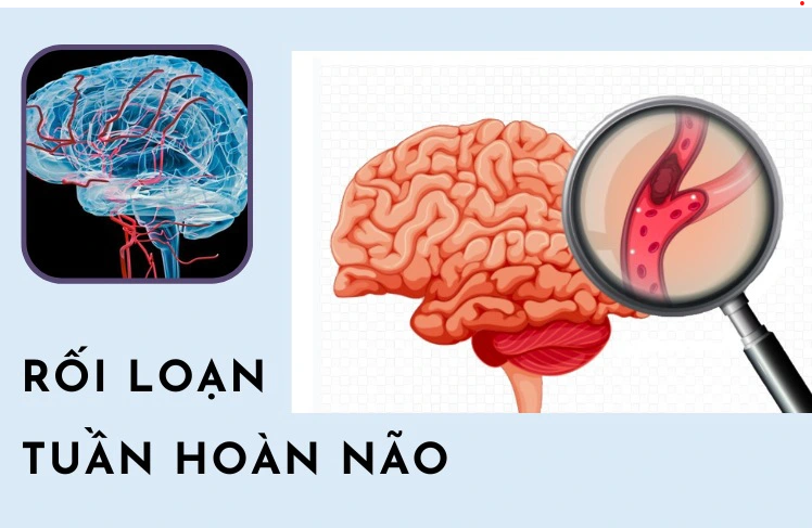 Rối loạn tuần hoàn não là gì? Cẩn trọng nguy cơ biến chứng đột quỵ, xuất huyết não