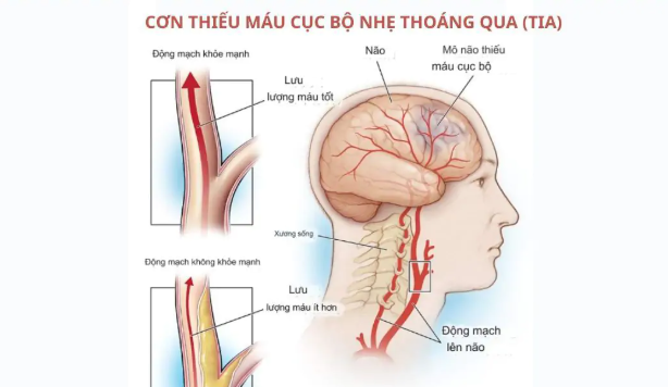 Điều trị cơn thiếu máu não thoáng qua ngăn ngừa nguy cơ đột quỵ nhồi máu não