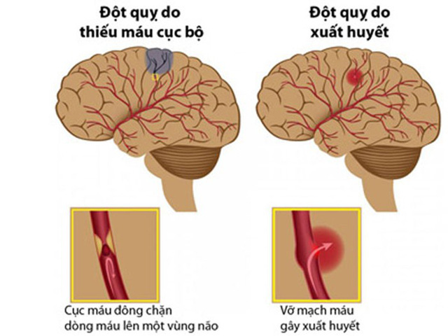 Tại sao cục máu đông trong não gây đột quỵ? Nhận biết sớm các dấu hiệu để bảo vệ tính mạng
