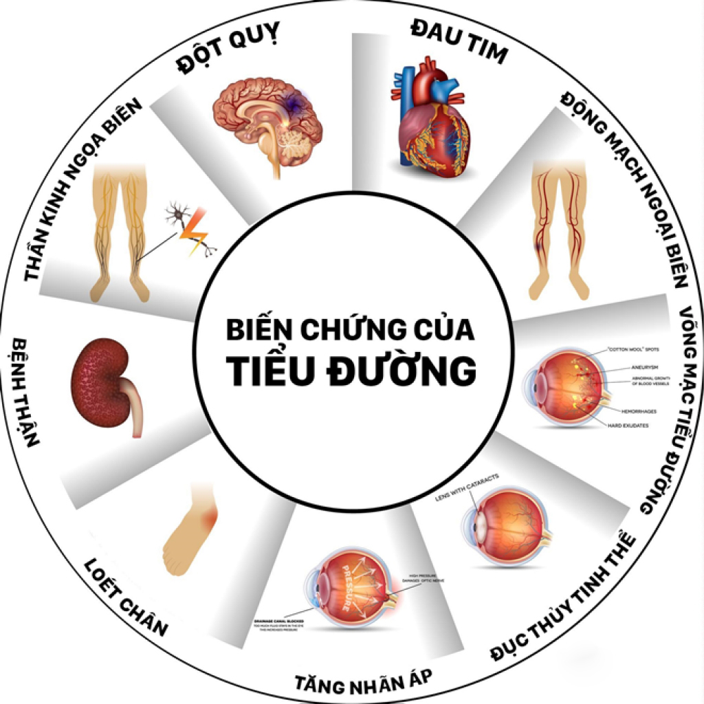 Biến chứng tiểu đường gây đột quỵ: Nên biết sớm, can thiệp kịp thời
