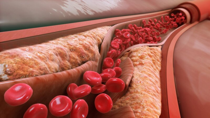 Vì sao cholesterol trong máu cao gây đột quỵ? Tuyệt chiêu kiểm soát lượng cholesterol ai cũng cần phải biết