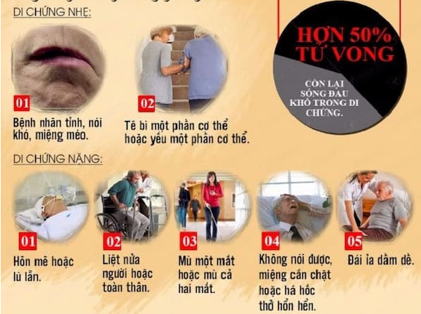 Tai biến nhẹ: Điểm danh những triệu chứng âm thầm nhưng cực nguy hiểm