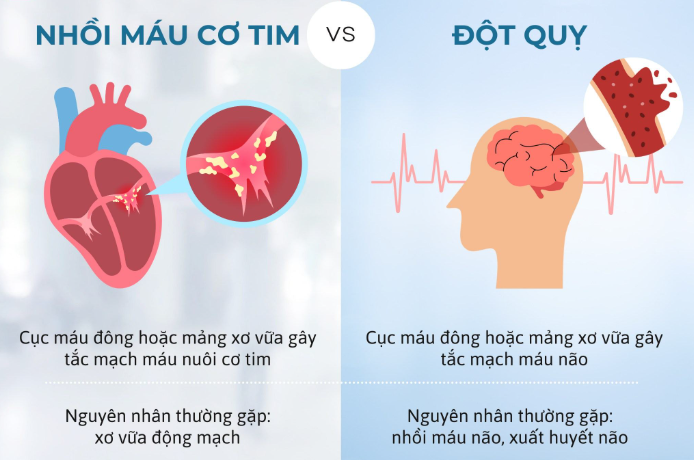 Hướng dẫn phân biệt đột quỵ và nhồi máu cơ tim: Nguyên nhân, triệu chứng, cách phòng tránh