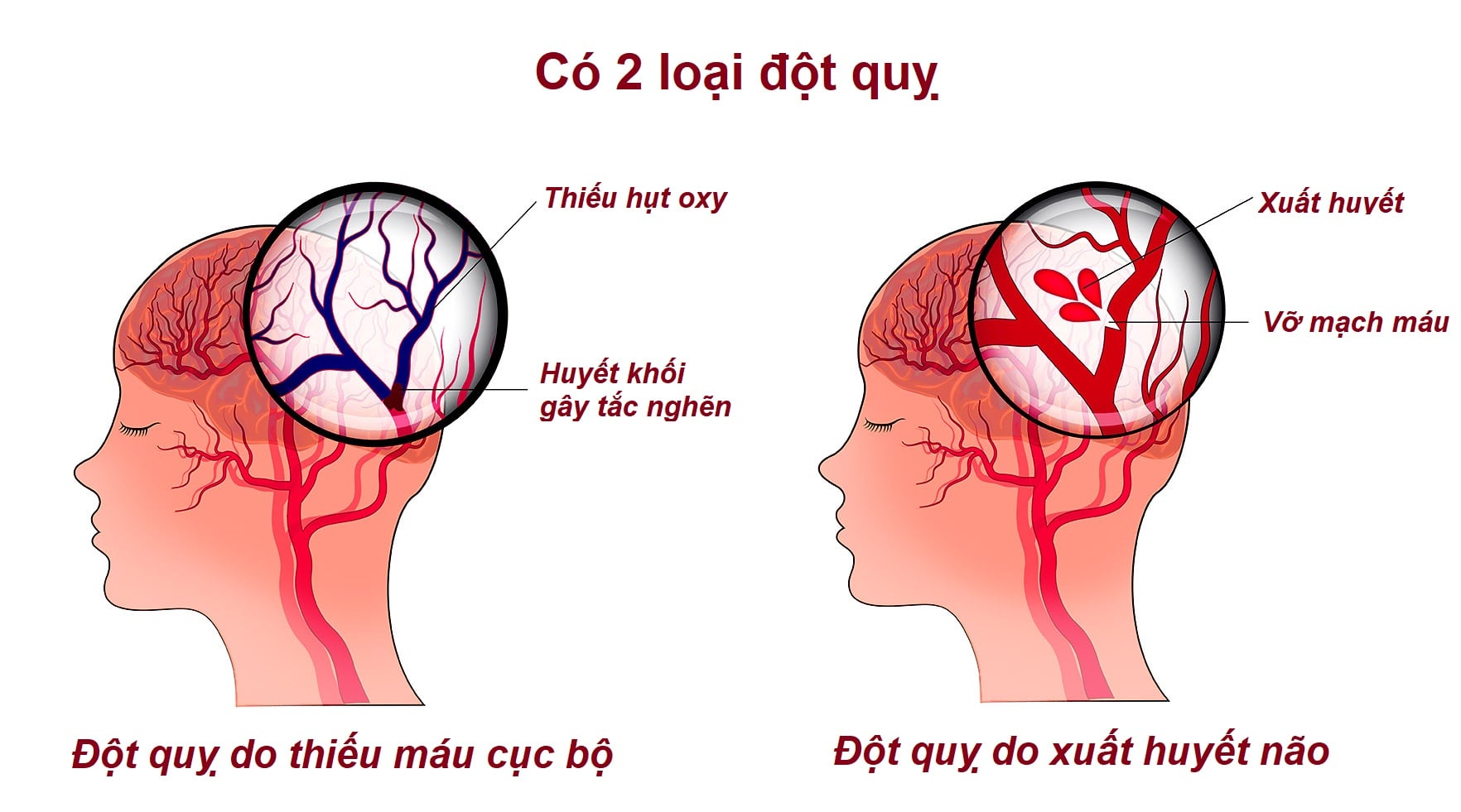 Hướng dẫn phân biệt trúng gió và đột quỵ: Lưu ý quan trọng trong cấp cứu