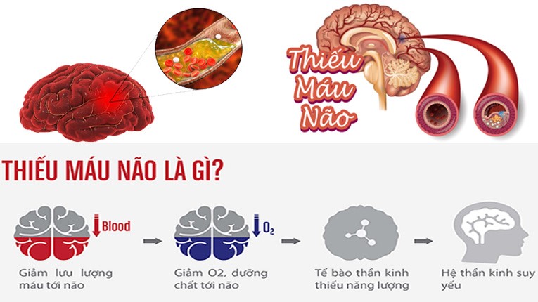 Top 5 nguyên nhân gây thiếu máu não đang âm thầm phá hủy não bộ: Bạn có đang gặp phải?