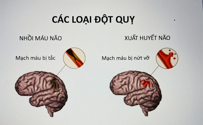 Đột quỵ và tai biến mạch máu não có gì khác biệt? 90% người bệnh nhầm lẫn điều này