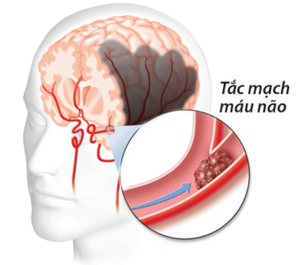 Tắc mạch máu não: “Sát thủ” gây tổn thương vĩnh viễn cho não bộ
