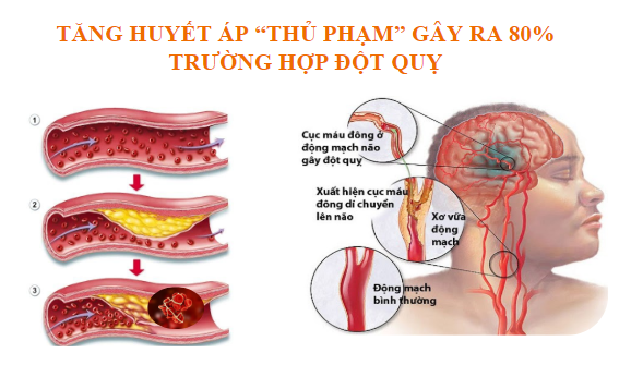 Đột quỵ do tăng huyết áp: Mối nguy hiểm rình rập