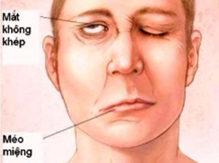 Trúng phong là gì? Nguyên nhân, triệu chứng và phương pháp điều trị theo Đông y
