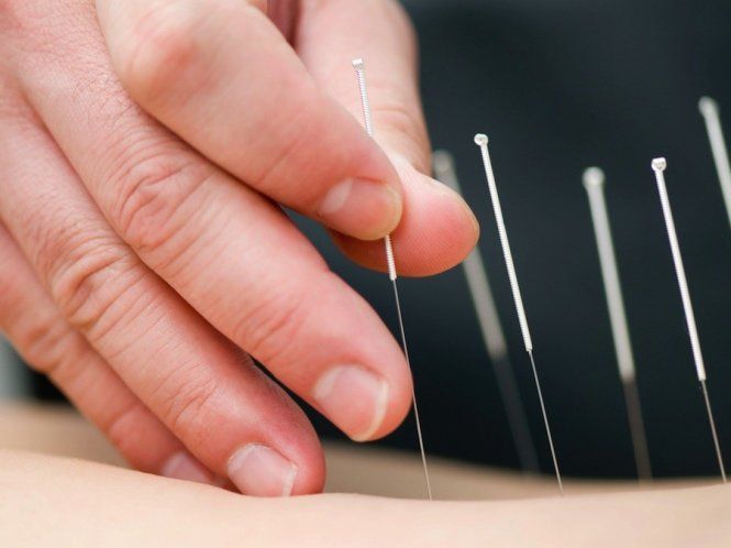 Châm cứu liệt nửa người cải thiện di chứng sau đột quỵ