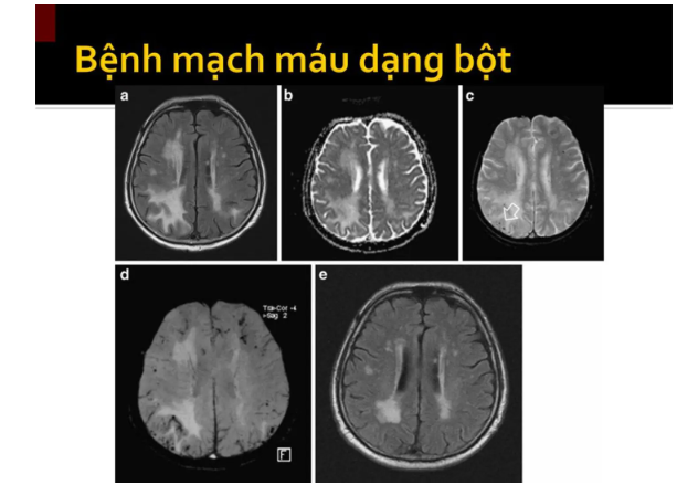 Bệnh mạch máu dạng bột nguy cơ tai biến mạch máu não