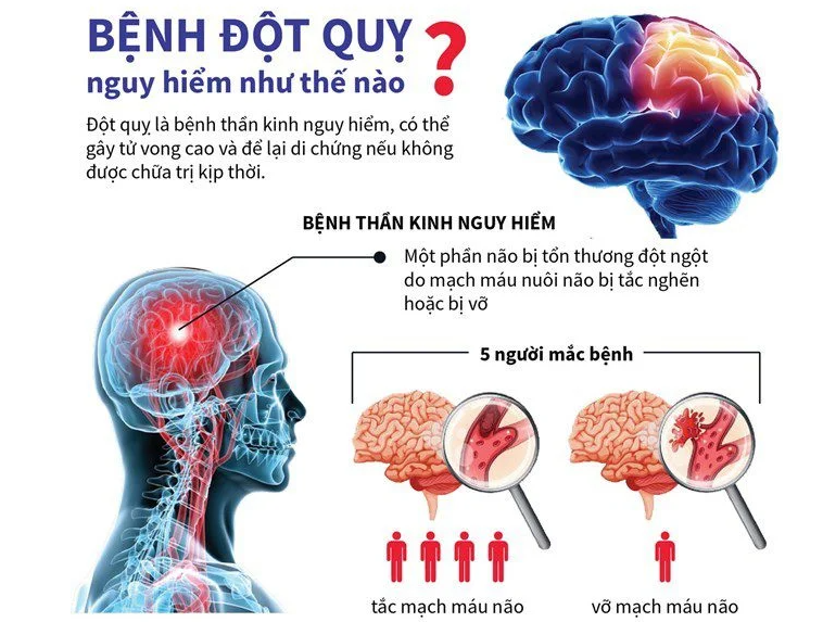 Chi phí điều trị tai biến mạch máu não bao nhiêu tiền? Bác sĩ chuyên khoa giải đáp