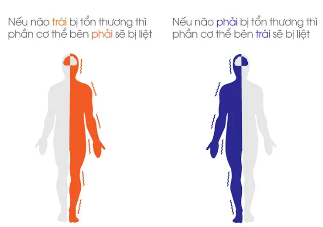 Phòng ngừa tai biến mạch máu não lần 2: Cần điều trị triệt để các yếu tố nguy cơ