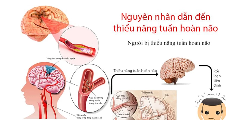 Nguyên nhân gây thiểu năng tuần hoàn não: Hiểu đúng để phòng tránh hiệu quả
