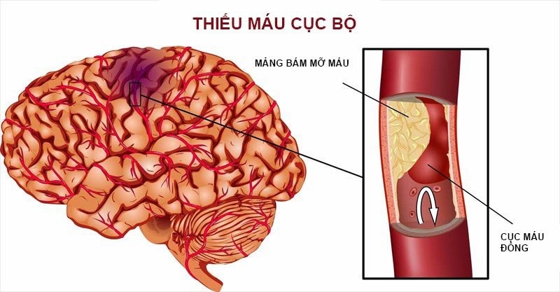 Thiếu máu não cục bộ: Dấu hiệu cảnh báo đột quỵ bạn không thể bỏ qua