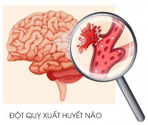 Phân loại tai biến mạch máu não: Hiểu rõ để phòng ngừa
