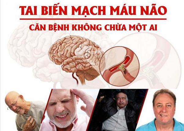 Cách điều trị tai biến mạch máu não theo Y học hiện đại giúp giảm biến chứng, tăng cơ hội hồi phục