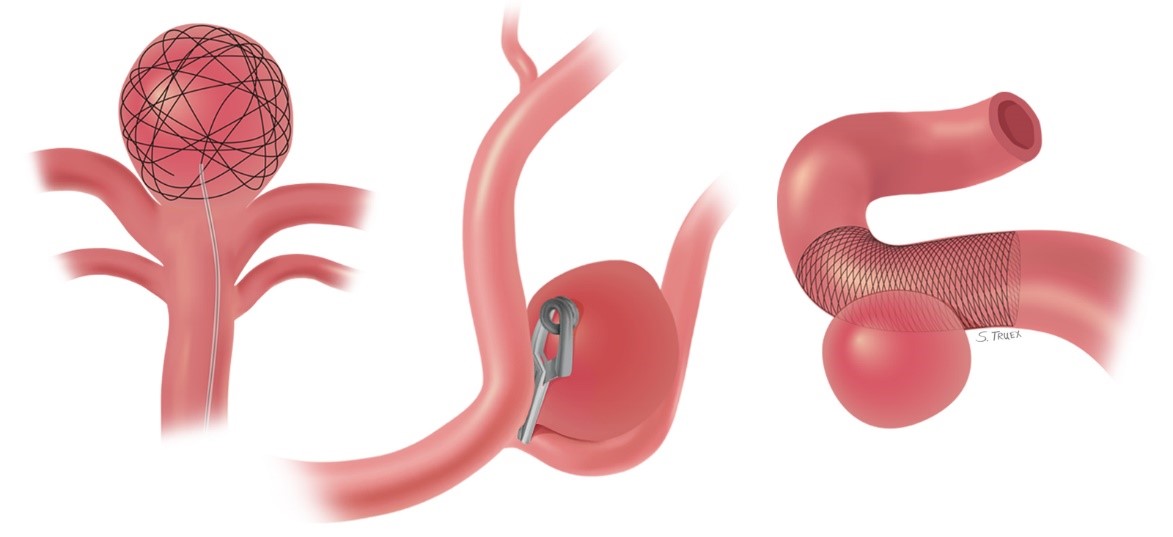 Tổng hợp các phương pháp điều trị tai biến mạch máu não phổ biến nhất hiện nay