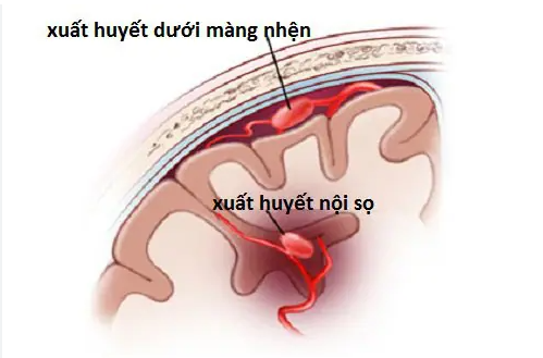 Xuất huyết nội sọ và những biến chứng đe dọa sức khỏe