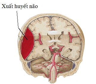 Các loại xuất huyết não: Nguyên nhân, dấu hiệu và cách điều trị