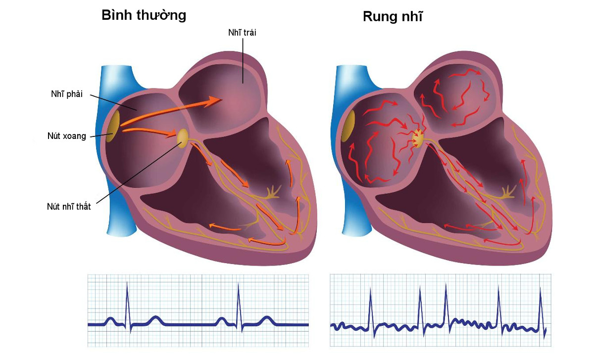 Rung nhĩ làm tăng nguy cơ đột quỵ: Giải thích từ bác sĩ chuyên khoa